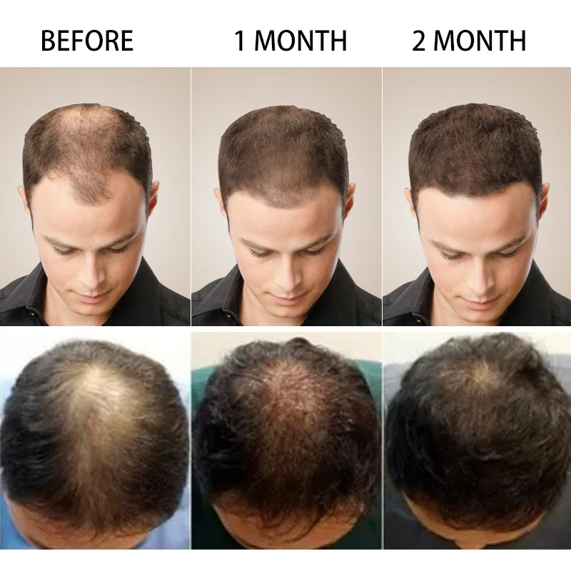 Hair Growth Shampoo for Thickener Regrowth Fast Growth Hair Serum  Treatments Oil for Anti Hair Fall Loss Care Products Men Women - erifashion
