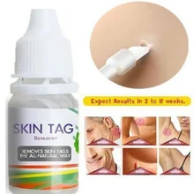 10ml Skin Tag Remover Wart Treatment Papillomas Removal Liquid Against Moles Remover Anti Verruca Remedy Ointment