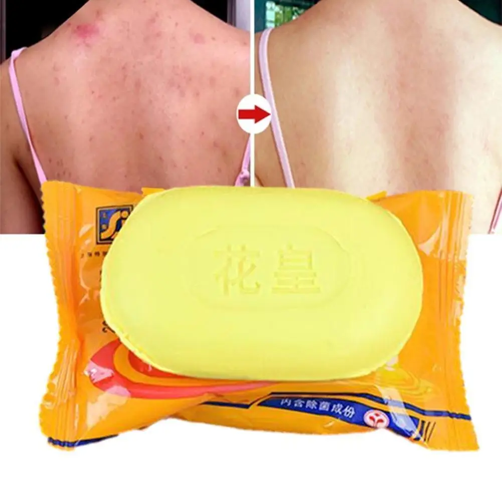New 85g Sulphur Soap Skin Care Dermatitis Fungus Eczema Whitening