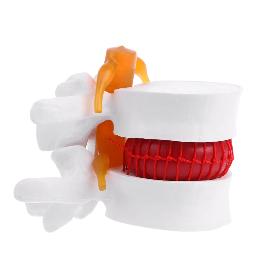 

Drop Ship Human Anatomical Lumbar Disc Herniation Model Medical Learn Aid Anatomy Instrume