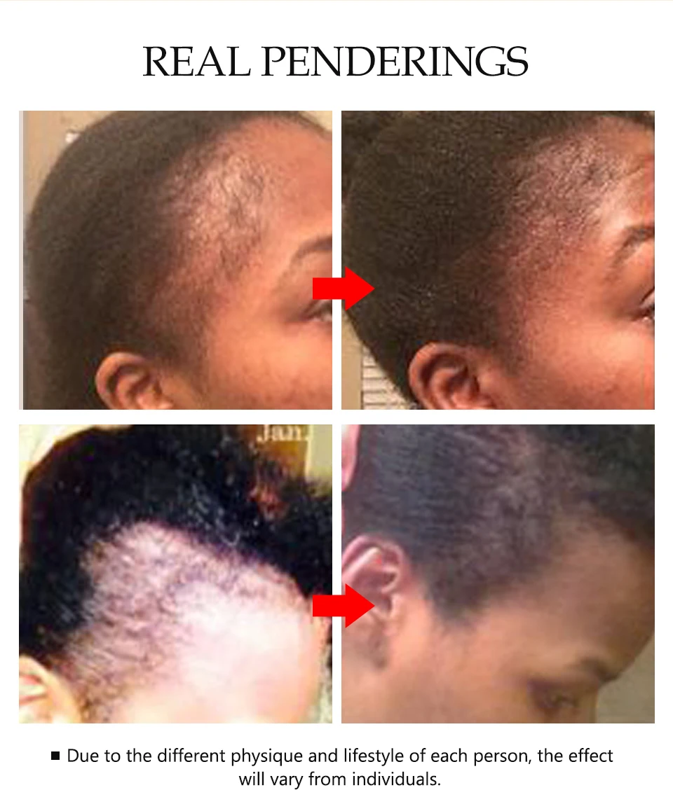 Быстрая эссенция для волос, натуральная травяная терапия, лечение выпадения волос, делает рост волос длиннее и гуще, продукты для ухода за волосами