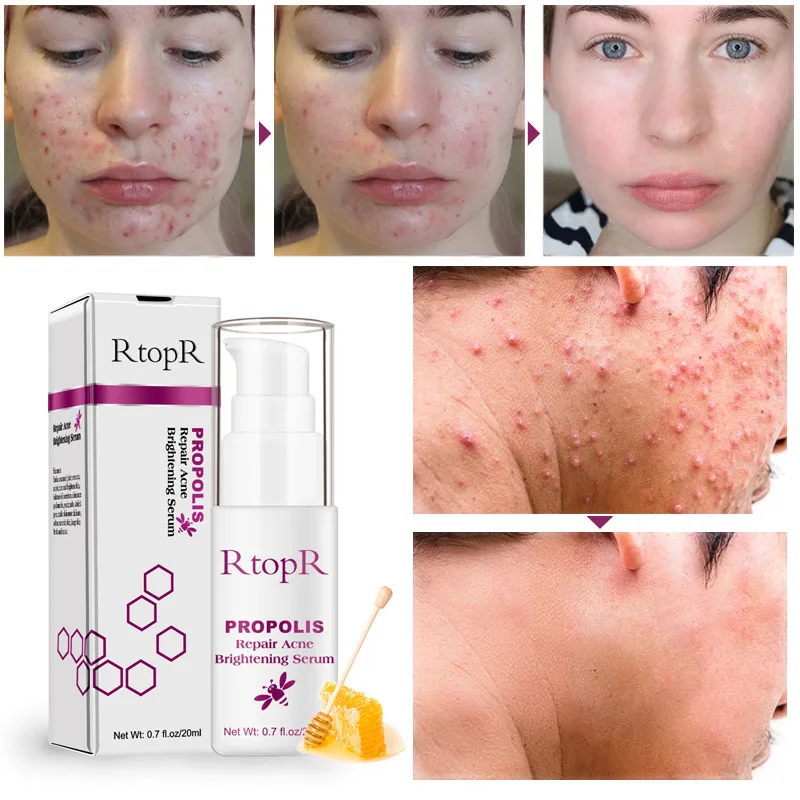 

Face Serum Acne Treatment Skin Care Natural Honey Extract Brightening Essence Hyaluronique Acid Vitamin Fce Care