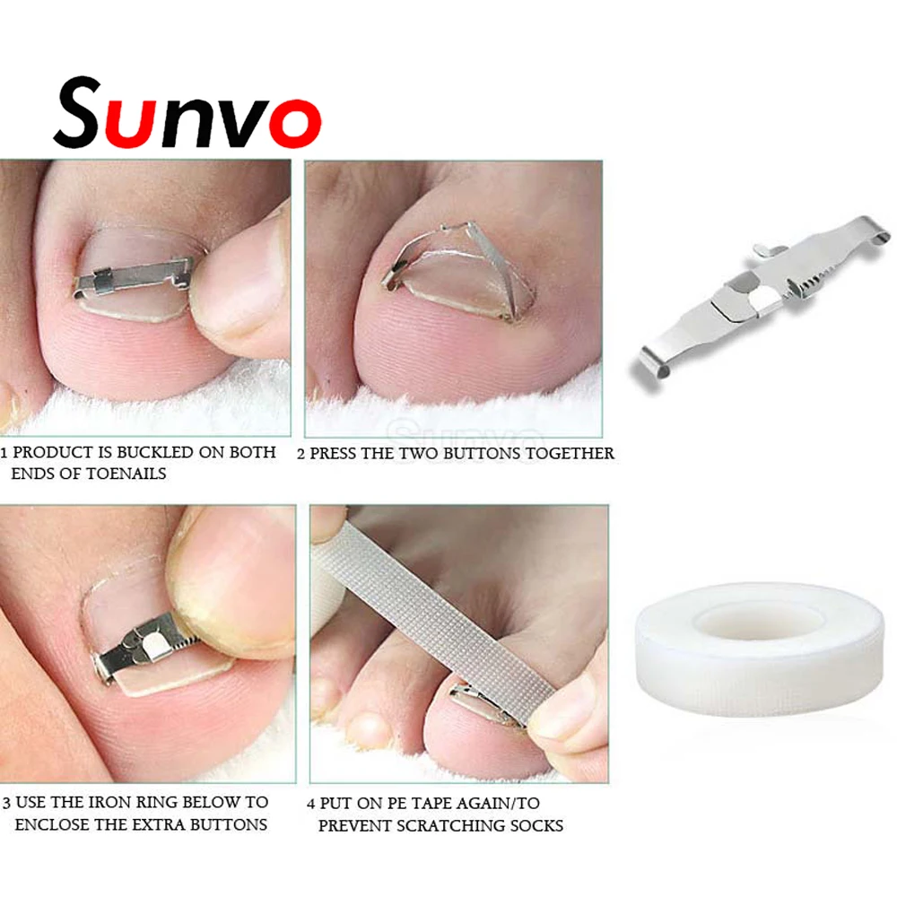

Sunvo Ingrown Toenail Stainless Steel Toenail Correction Toe Nail Treatment Inset Buckle Pressure Sensitive Tape Pedicure Tools