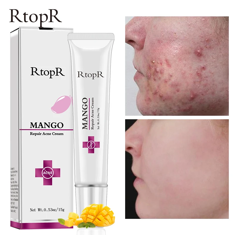 

Acne-Treatment Face Cream Blackhead Repair Gel Oil-Control Shrink Pores Acne Scar Whitening Moisturizing Cream Korean Cosmetics