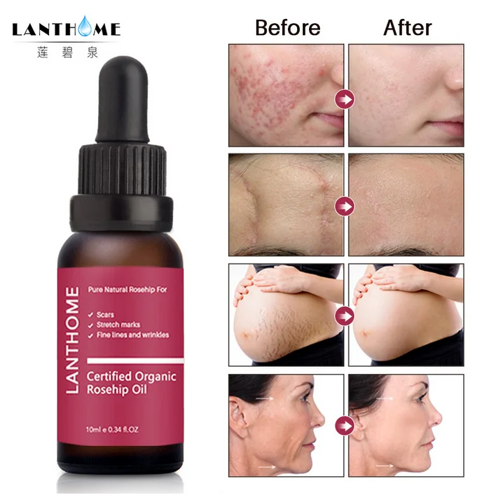 Lanthome Rose fruit oil, repair scars, eliminate wrinkles, increase skin luster