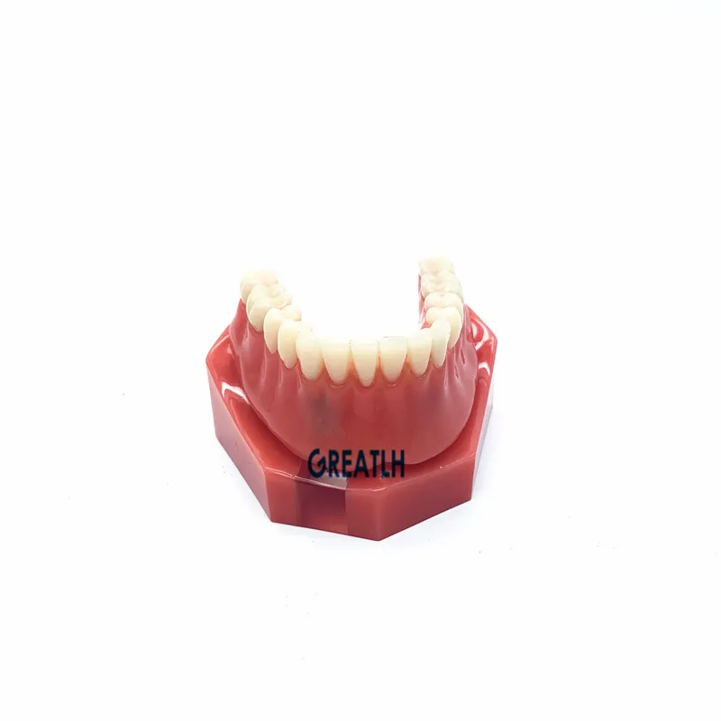 

Overdenture Inferior 2 Implant Dental Teeth Model Dental school educational Teeth model Teaching