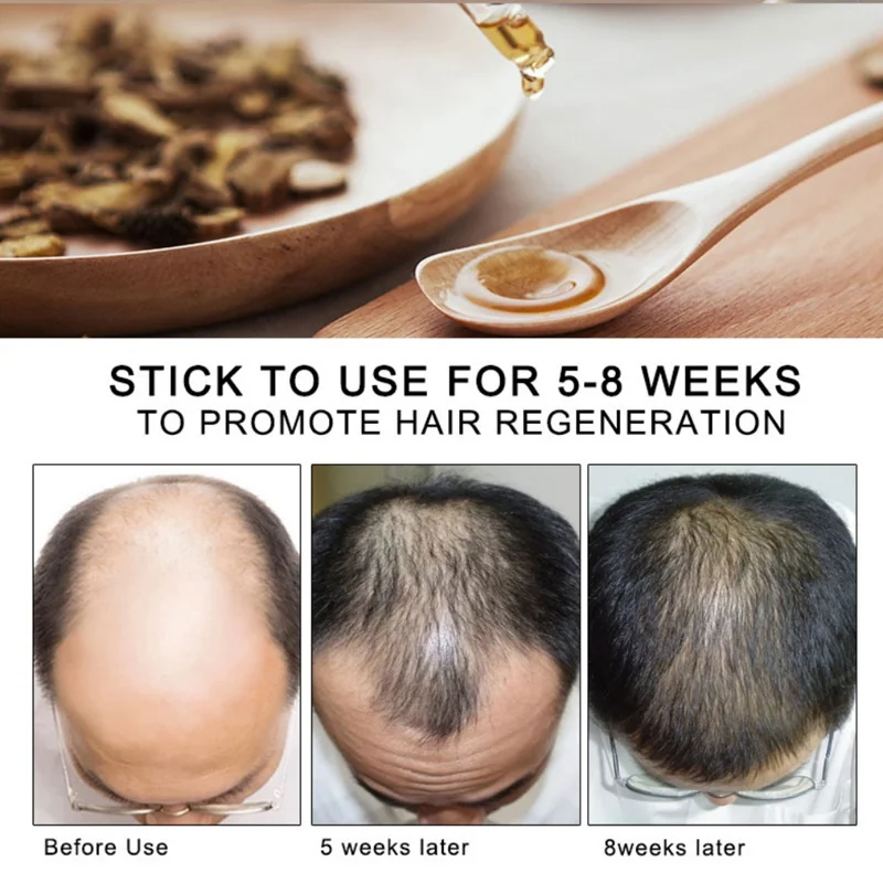 30 мл средство против выпадения волос эфирное масло для роста волос эссенция спрей для предотвращения облысения укрепляющее питание корни волос