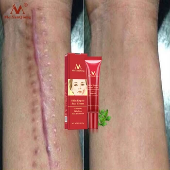 

Remove Scar Cream Repair Burn Skin Desalination Surgical Scar Effectively Remove Melanin Deposition Restore Smooth Skin 15g