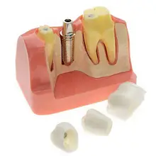 Съемные зубные зубы реставрация имплантата модель патологического имплантата модель нерва для анализа стоматологической болезни демонстрационный инструмент