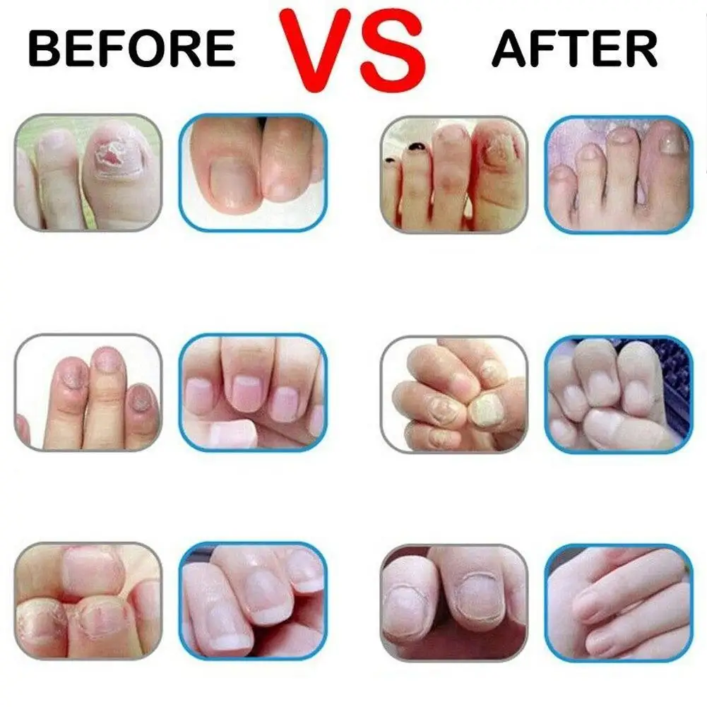 Средство для удаления грибка на пальцах пальцев ног для удаления оныхомикоза