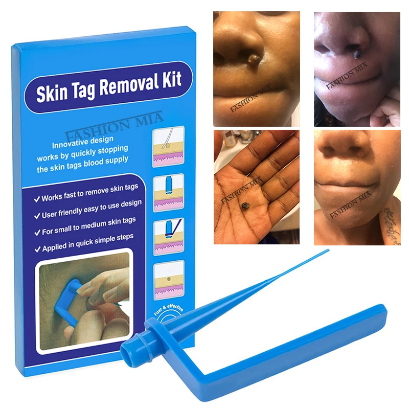 How To Get Rid Of Skin Tags Under Armpits