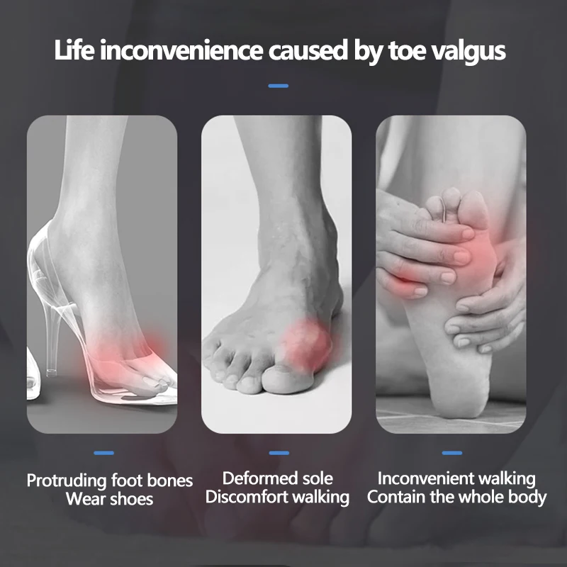 2pcs Silicone Bunion Corrector Toe Separators Foot Corrector Straightener For Toes Haluksy Calluses Pad Hallux Valgus toe separators toe corrector
