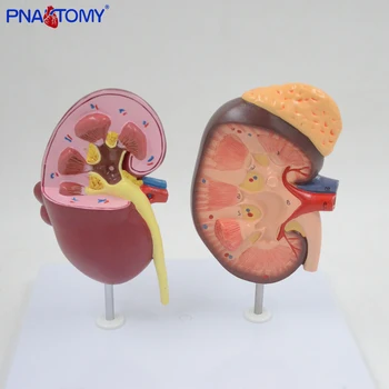 

Normal and Diseased Kidney Model Urinary System Renal Anatomy Medical Teaching Tool Educational Equipment