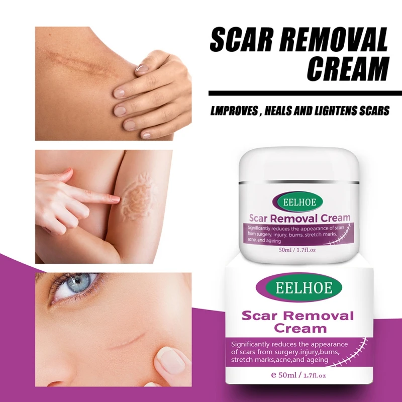 Scar Treatment Body Creams 50ml Scar Fading Scar Cream Face Pimples Scar  Stretch Marks Removal Acne Treatment Face Pimples Scar - AliExpress Beauty  & Health