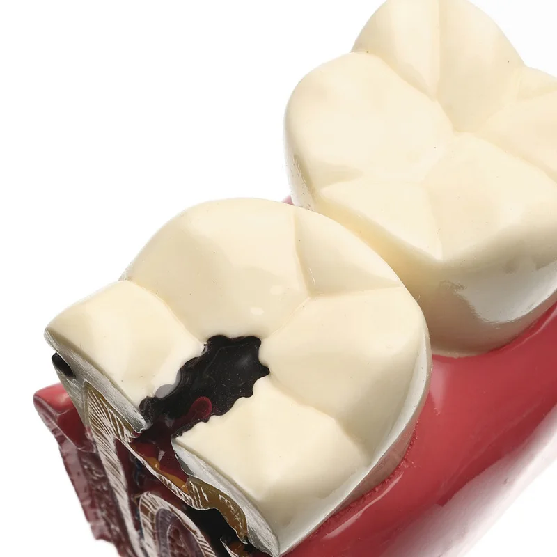 Goedkoop 1 stuks dental tanden model 6 Keer Cariës Comparation Studie kunstgebit Tand modellen Tandarts Studeren en Onderzoek Tandheelkunde product