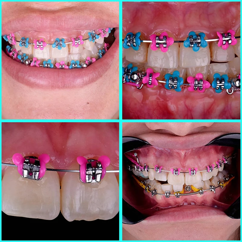 Bands Braces