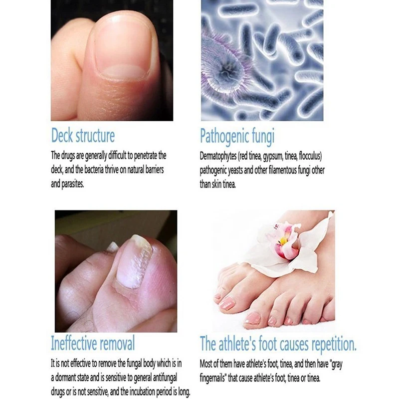 Совершенно новое Лечение ногтей от грибка ручка Onychomycosis Paronychia противогрибковые инфекция ногтей китайский травяной уход лечебная жидкая ручка