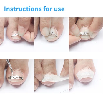 

Ingrown Toe Nail Correction Wire Fixer Pedicure Paronychia Recover Toenails Corrector Foot Care Tool High Quality