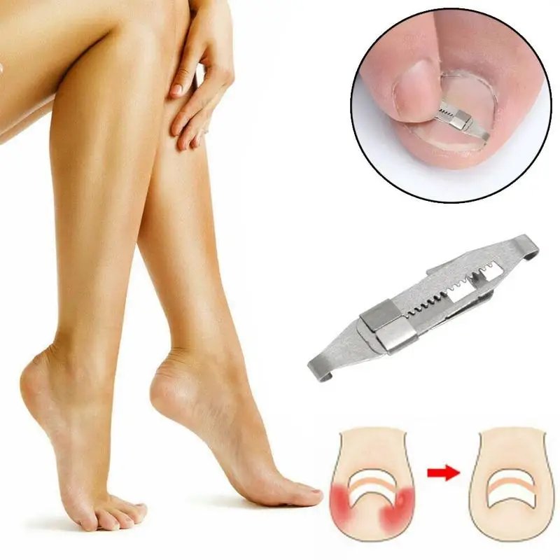 Ingrown Toenail Corrector Toenail Correction Treatment Foot Care Tools Orthotic Nail Fixer Corrector Pedicure Recover Embed Tool Ingrown Toenail Corrector Toenail Correction Treatment Foot Care Tools Orthotic Nail Fixer Corrector Pedicure Recover Embed Tool