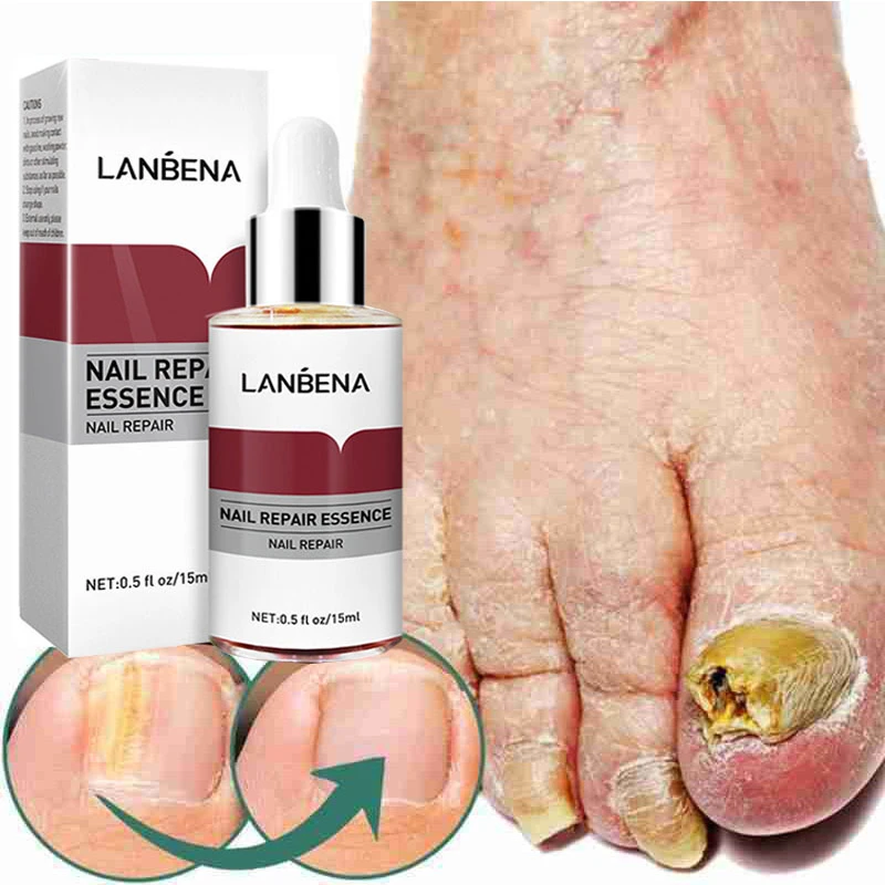 Nail Fungus Treatment Cream Onychomycosis Paronychia Anti Fungal Herbal