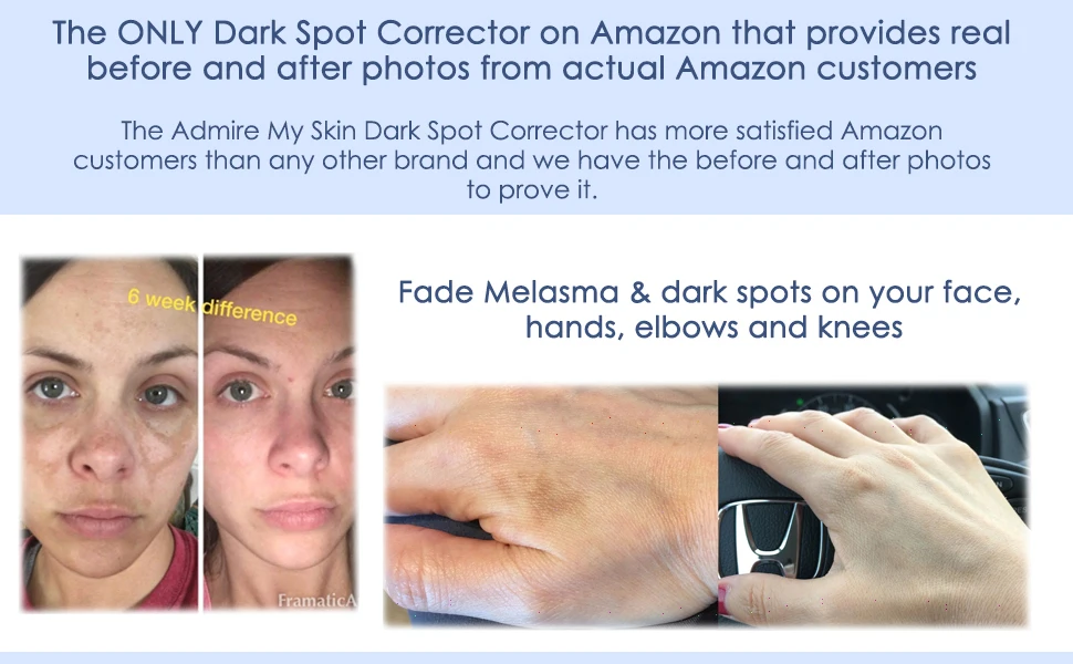 Dark Spot Corrector Remover For Face& Melasma Treatment Fade Cream- Contains Vitamin C, Salicylic Acid, Kojic Acid