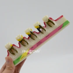 Modelo de doença periodontal dentes doentes modelo de equipamento educacional recursos de ensino ciências médicas demonstração odontológica
