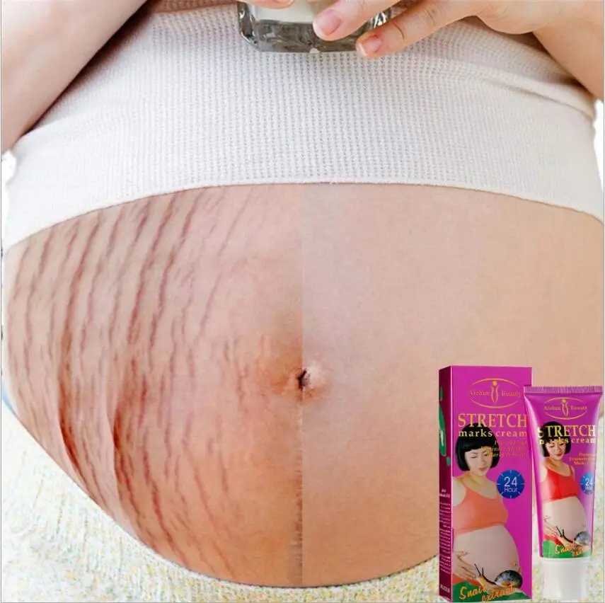 

120G Natural Mild Non-irritating Snails Stretch Mark Cream For Pregnancy Repair Scar Slack Line Abdomen Stretch Marks Cream