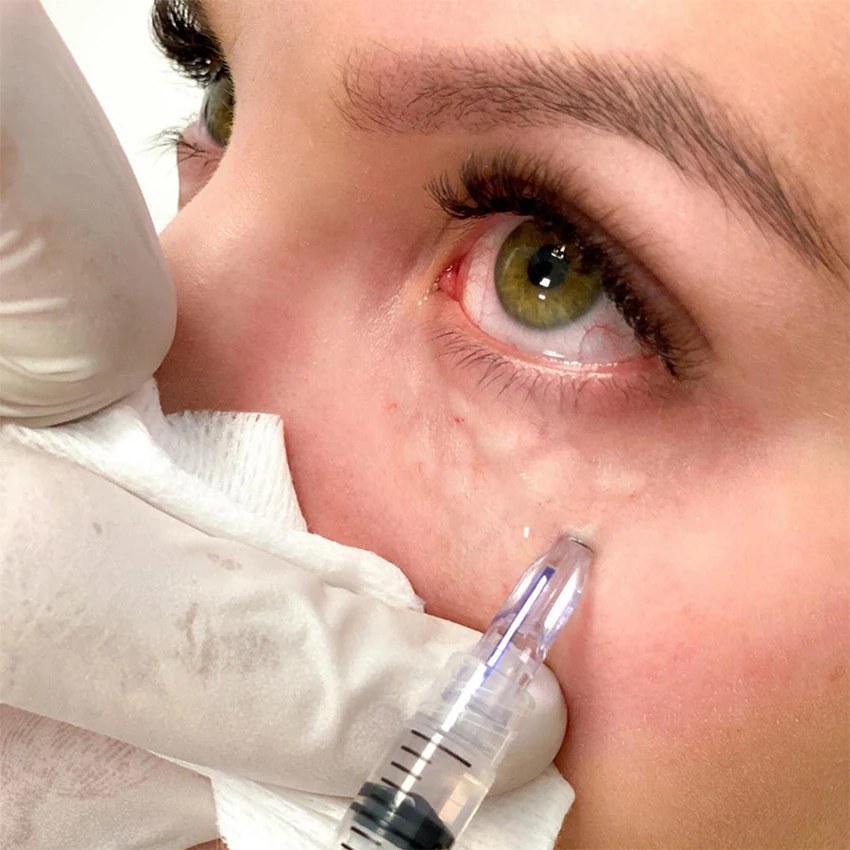 Nanosoft Fillmed Microneedles 34G Nanosoft Needle 3pin 0.6mm