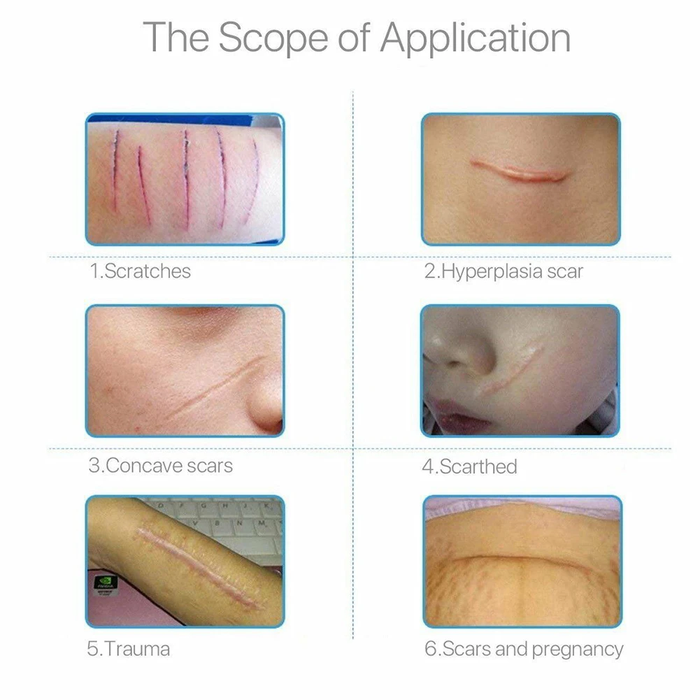 Полоски для удаления шрамов, очищающие, для восстановления кожи, самоклеющиеся, послеродовые, дышащие, многоразовые, силиконовый гель