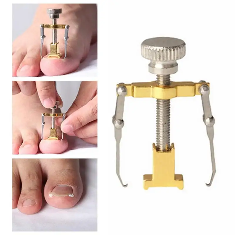 Metal Orthopedic Supplies Ingrown Toe Nail Recover Tool Pedicure Toenail Fixer Pedicure Foot Nail Care Nail Bunion Corrector
