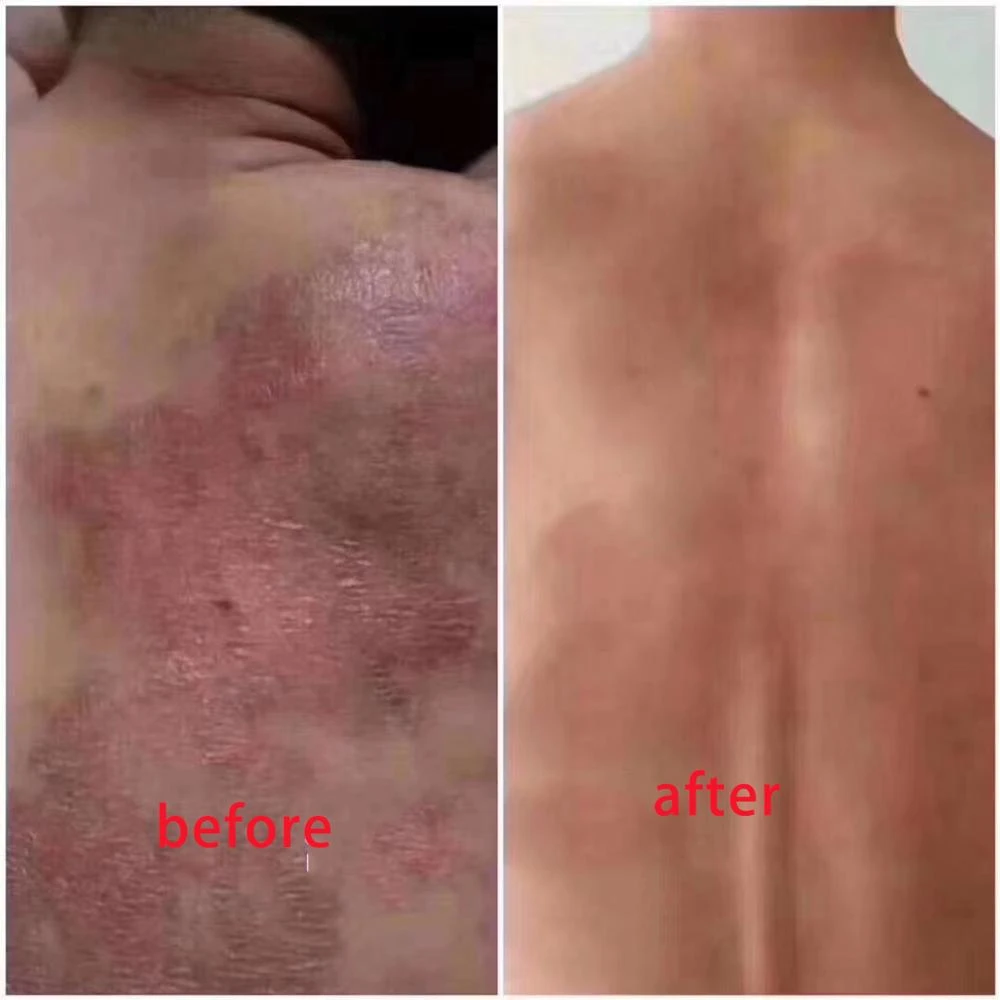 bekas psoriasis