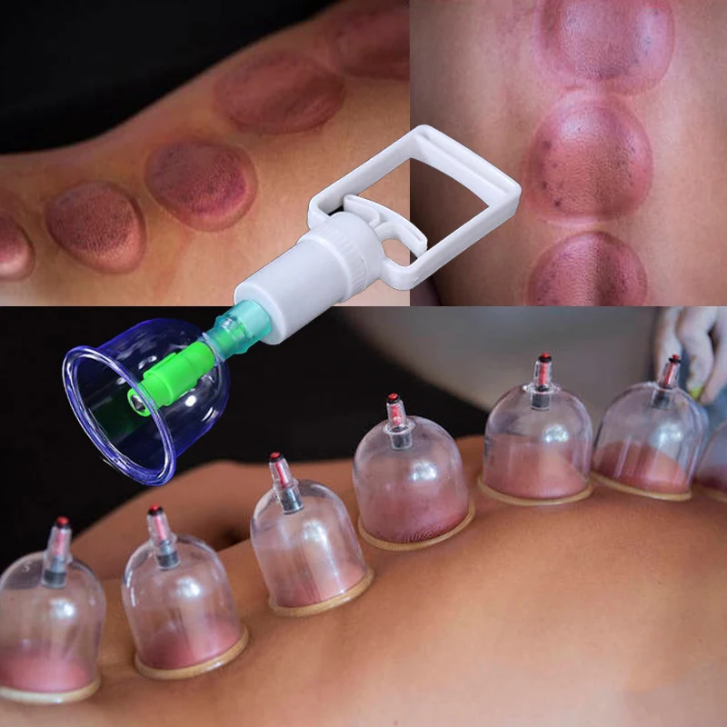 vacuum cupping cups (13)