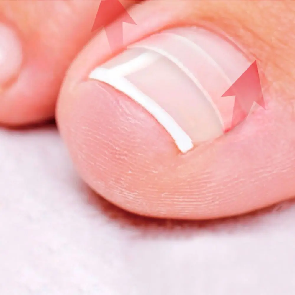 10pcs Ingrown Toe Nail Corrector Parches Stickers Paronychia Correction Treatment Elastic Sticker Foot Care Tools