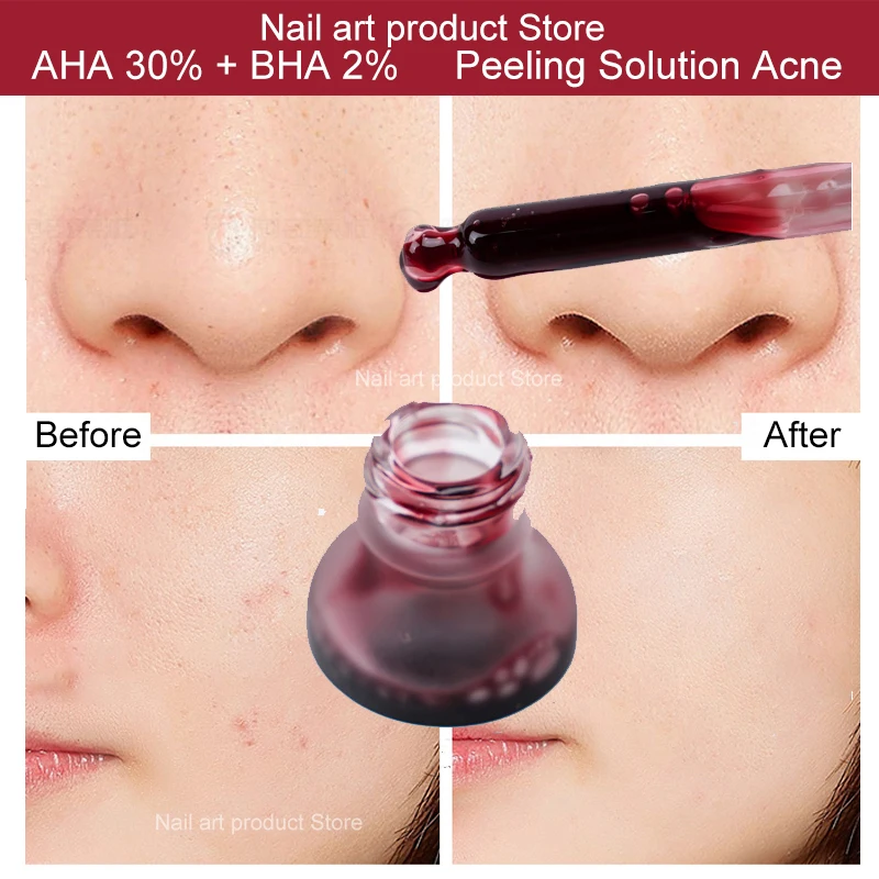 ordinary aha bha acne