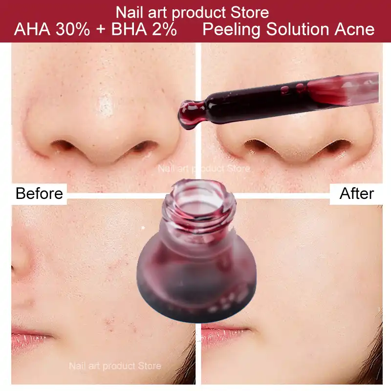acne peeling solution