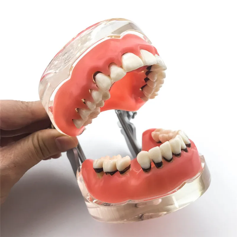 Dental Periodontal Disease Model - Shows 5 Stages From Gingivitis To Bone Loss (Model M4010)