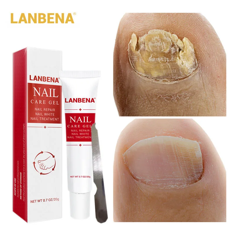 

LANBENA Nail Fungus Removal cream Treatment Onychomycosis Paronychia Anti Infection Feet Toe Nail Care Gel Fungal Nail Product