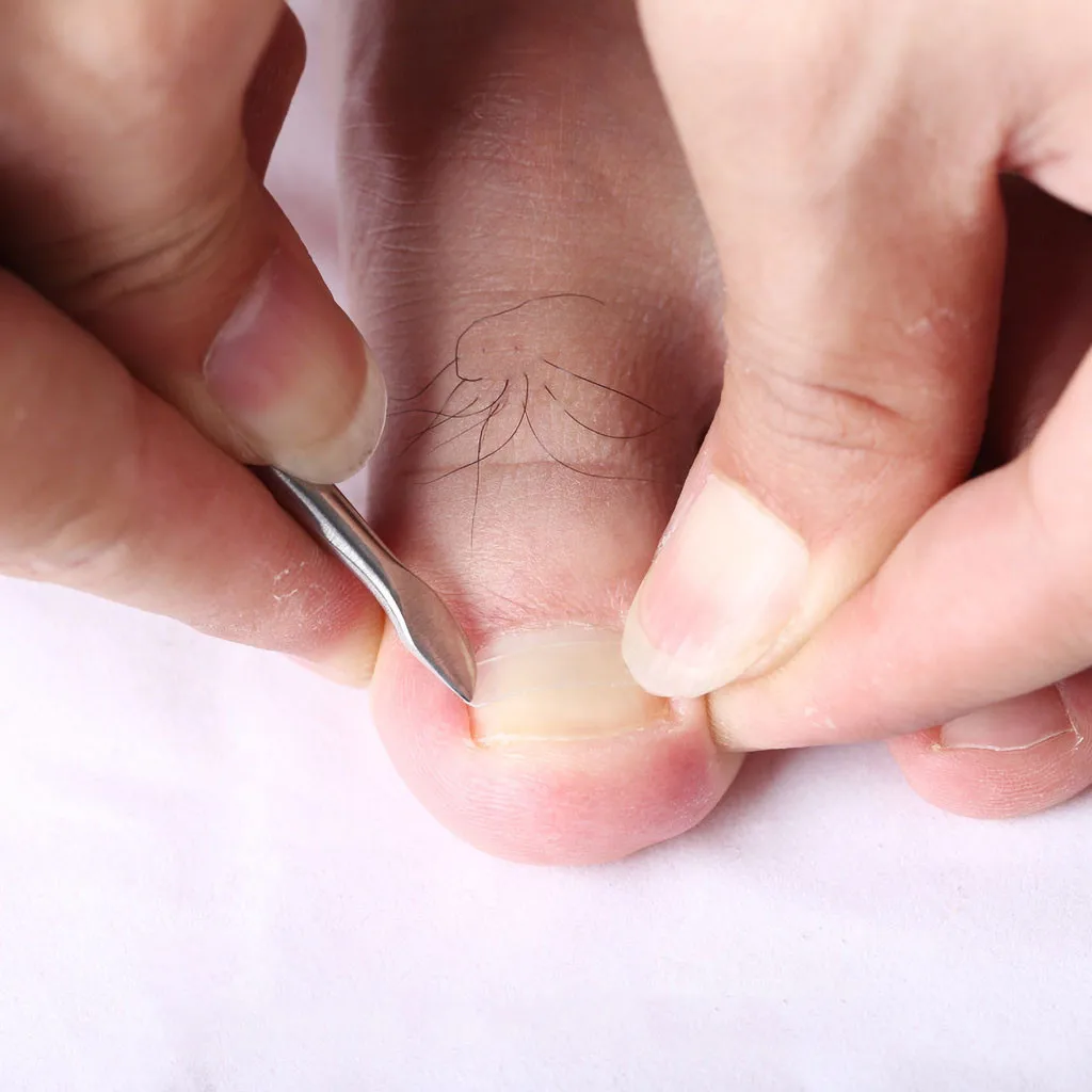 10 шт. ортодонтический Toenail патч для ухода за ногами Paronychia лечение педикюр инструменты ингредиент фиксация силы Уход за ногами пилка для ног