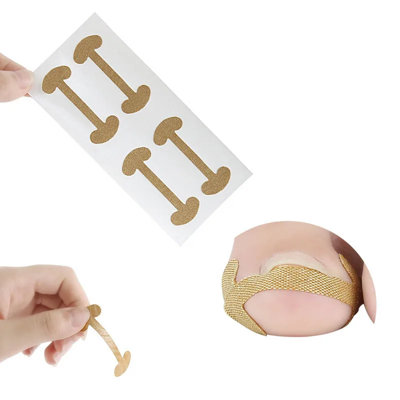 

High Quality 4 Pieces of Nail Orthodontic Device Embedded In The Treatment of Onychomycosis Restore Orthodontic Pedicure Tools