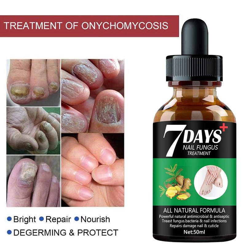 Nail Fungus Treatment Essence Serum Care Hand and Foot Care Removal Repair Gel Anti-infective Paronychia Onychomycosis