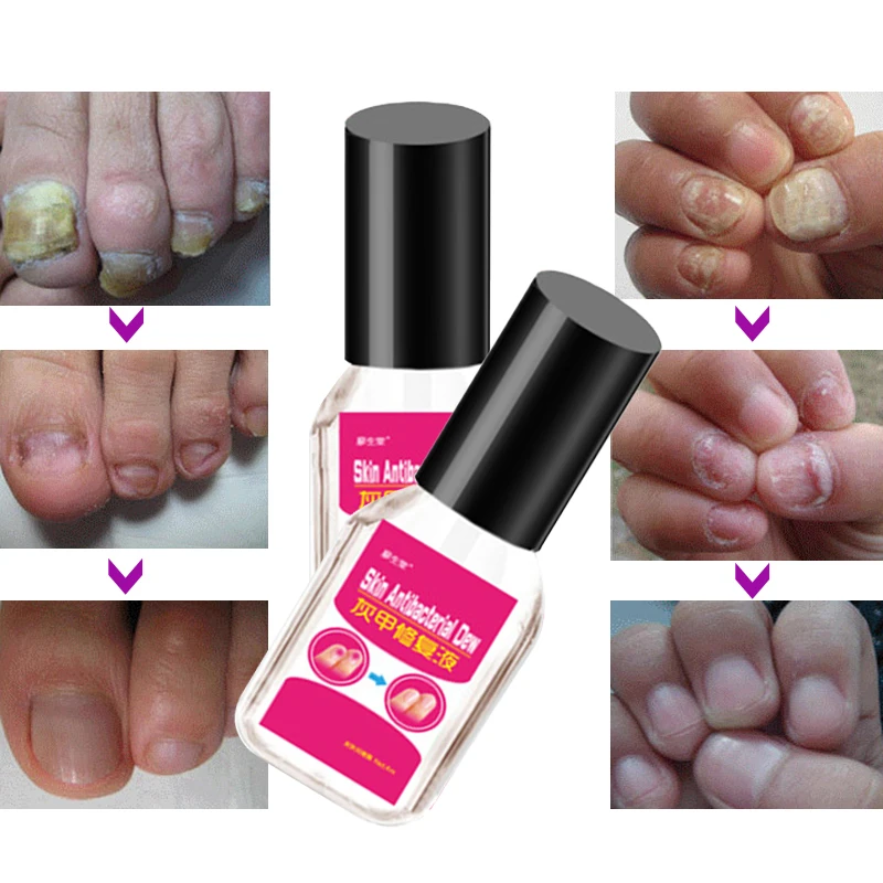 Купить Natural Herbal Medicine Nail Anti Onychomycosis Paronychia