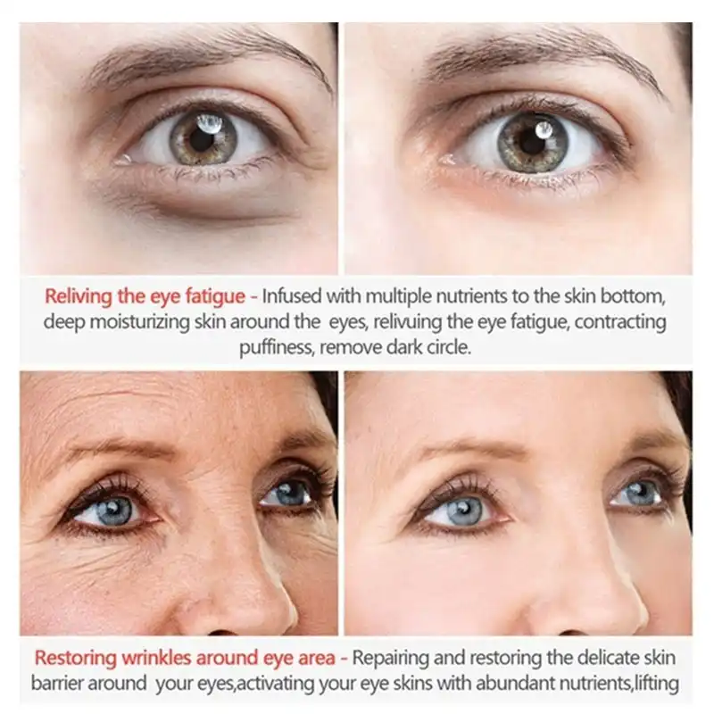 bag lines under eye