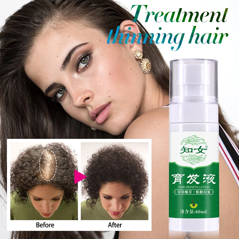 Hair Growth Bald Essence Spray Tonic Hair Loss Regrowth For