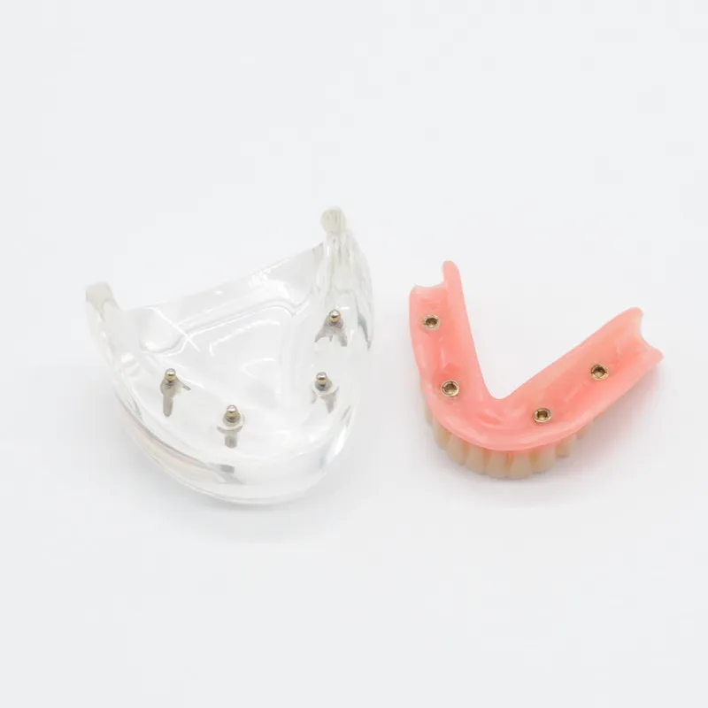 1pcs 4implants model Дантист Обучение Модель нижней челюсти с 2/4 имплантатов восстановление для стоматологической клинике - Цвет: 1pcs 4implants model