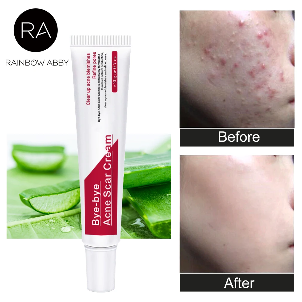 Acne Treatment Face Cream Anti Acne Scar Removal Pimple Blackhead Moisturizing Whiten Oil-control Shrink Pores Skin Care 20ML