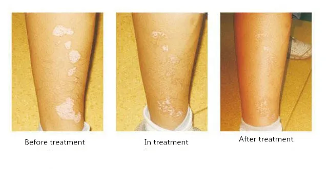 

50ml White spot Urticaria special liquid Eliminate white spot Sweat spot External face body