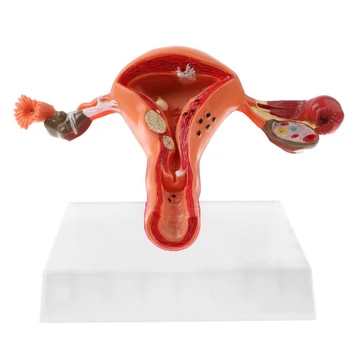 

New Ovary and Uterus Disease Dissection Model Pathology Uterus Model Teaching Human Medical Aids Anatomy Lesion Uterus