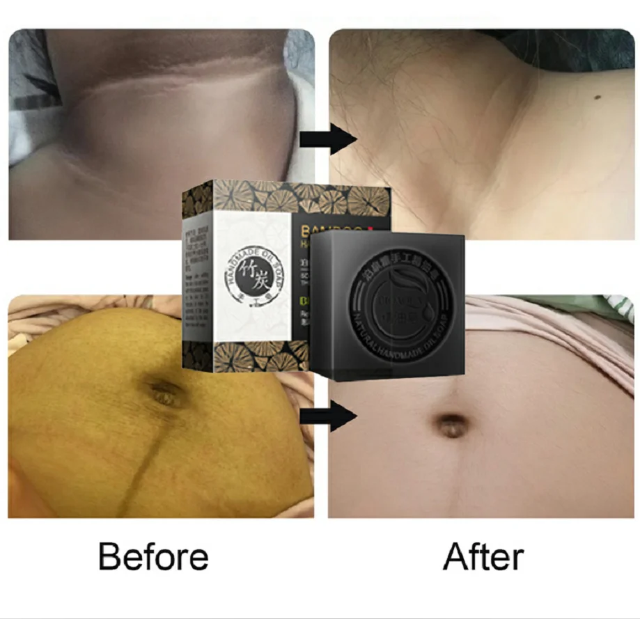 Sophora にきびクリーナー エッセンス 保湿 エッセンシャルオイル 石鹸 Aliexpress 男性女性のための100gフェイシャルクリーニングホワイトニングソープオイルコントロールフェイスケアエッセンシャルオイルハンドメイドソープ Tk Gov Ba