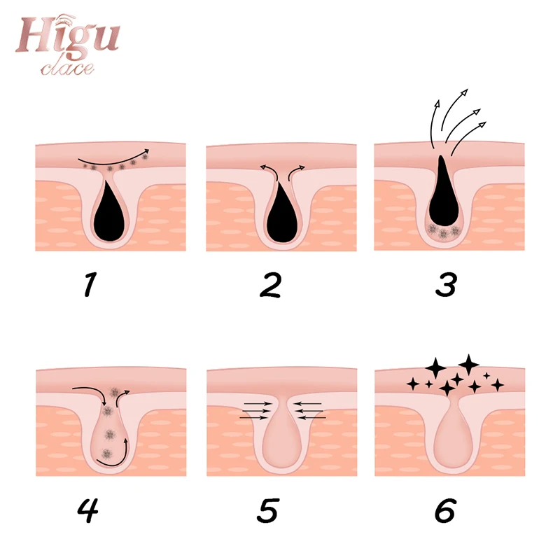 blackhead2 (7)