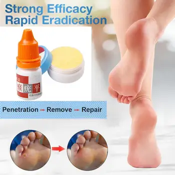 

Warts Treatment Liquid 5ml Cream 10g 12 Cotton Swab Suit Remover Skin Tag Skin Care Medical Ointment body scrub Care NatureTSLM1